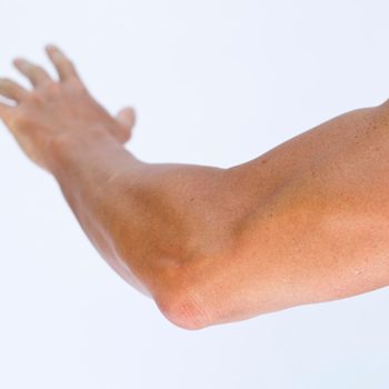 Tennis elbow is a type of chronic pain
